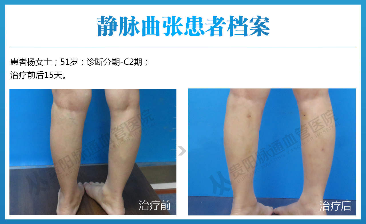 老烂腿