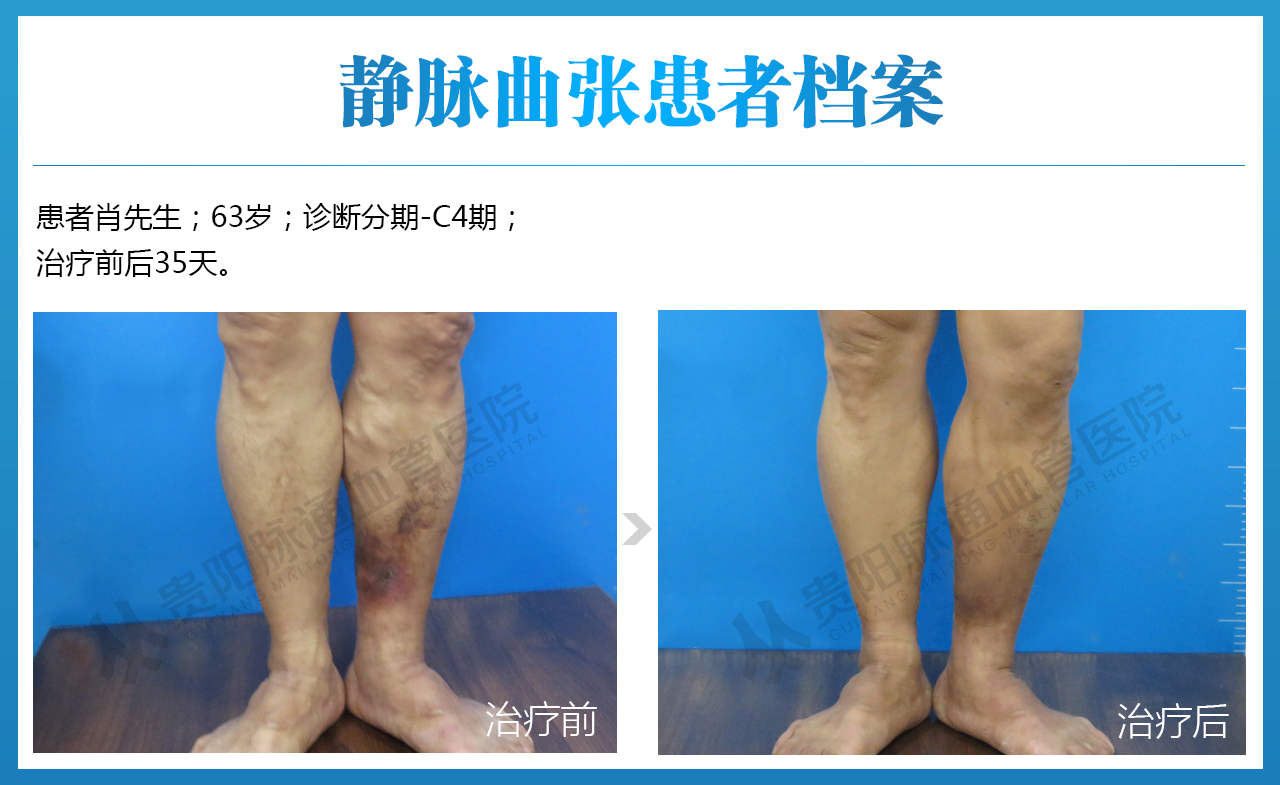 老烂腿